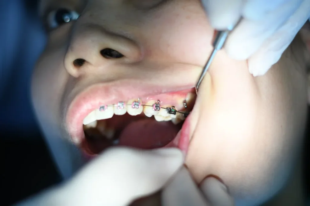 Brackets de ortodoncia fija colocados por el Prof. Dr. Carlos Chaparro en Bogotá